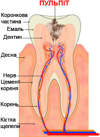 Пульпіт