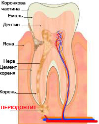 Періодонтит